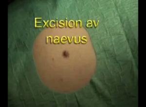 Naevusexcision 1