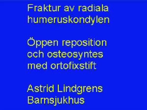 Humeruskondylfraktur, Radiell, Öppen Osteosyntes (ALB)