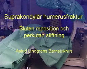 Suprakondylär Humerusfraktur, Stiftning (ALB)