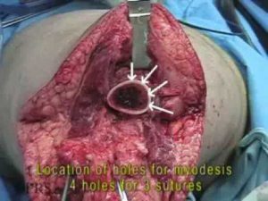 Transfemoral Amputation 1